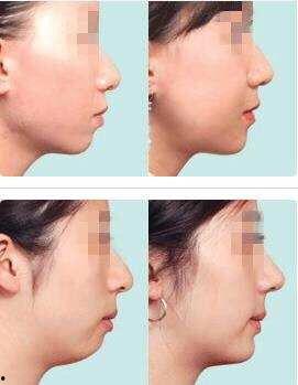 没有下巴的男明星,揭秘那些独特脸型的明星风采